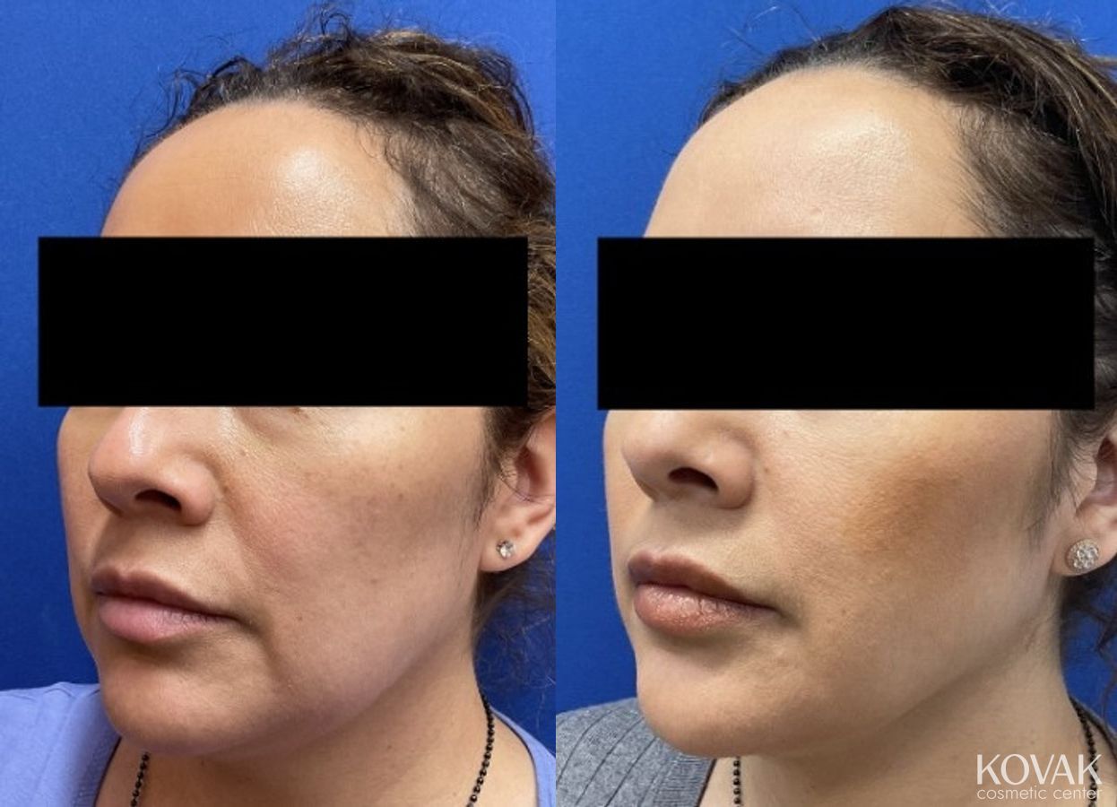Before and after VLR - Vaser Laser - Jawline Sculpting case 36763