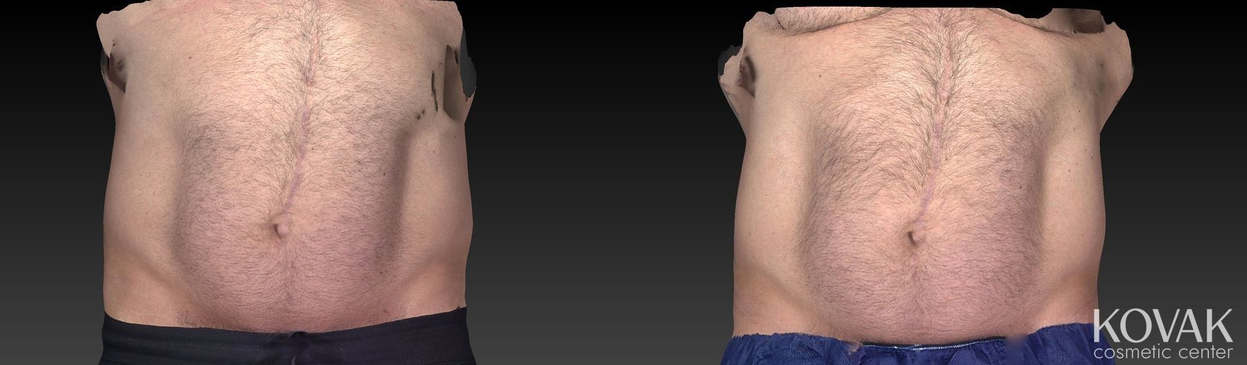 Before and after CoolSculpting® case 36562 - Angle 3
