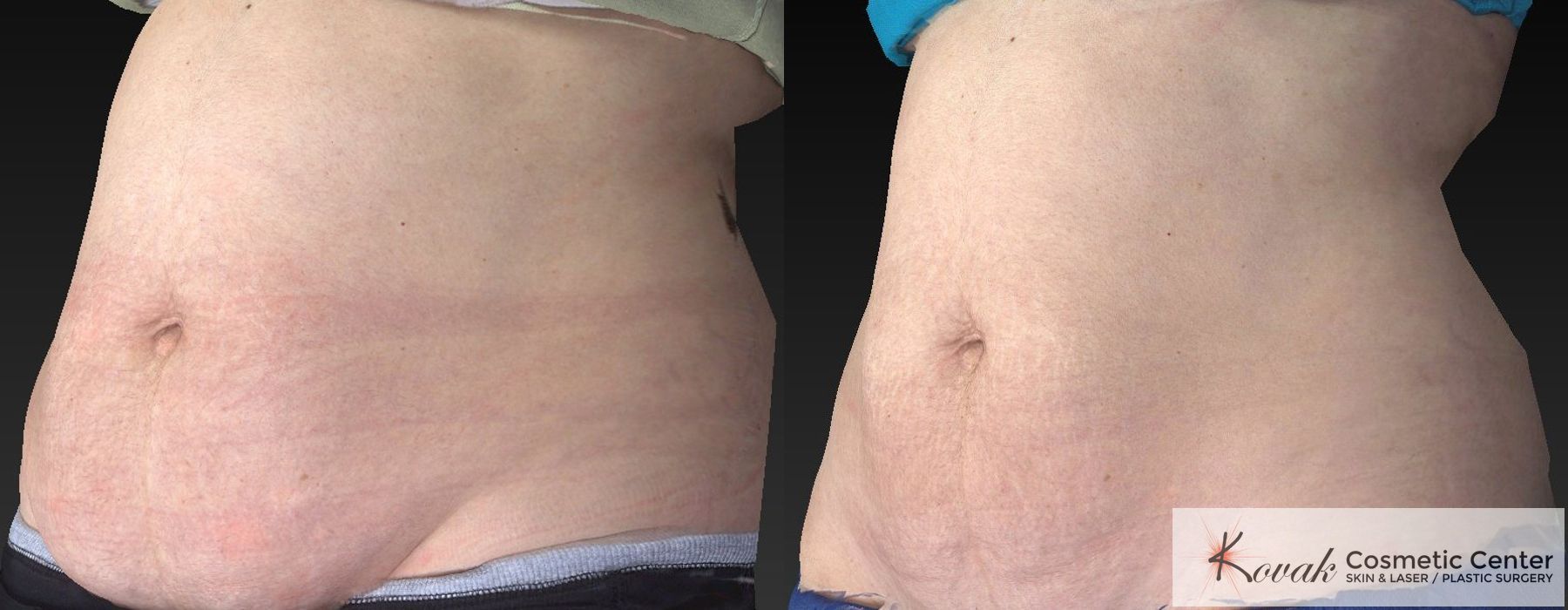 CoolSculpting® - Thumbnail 4