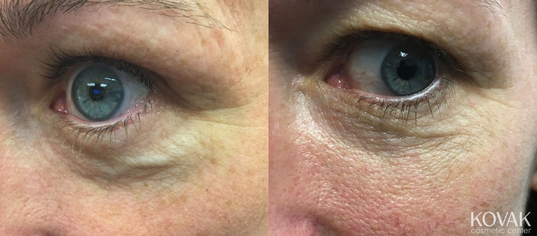 Before and after Eye Vein Treatment case 36521