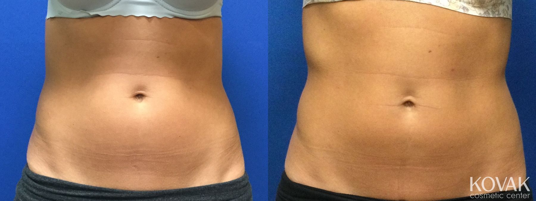 Before and after CoolSculpting® case 36690