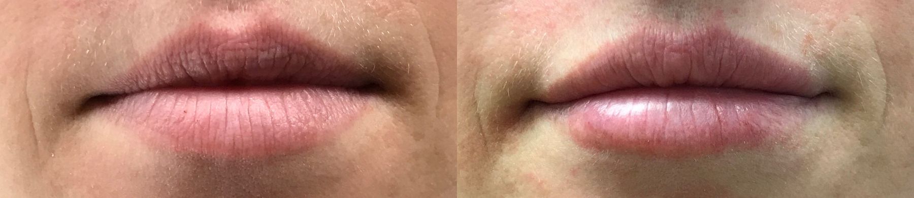 Before and after Restylane® case 36598 - Angle 3