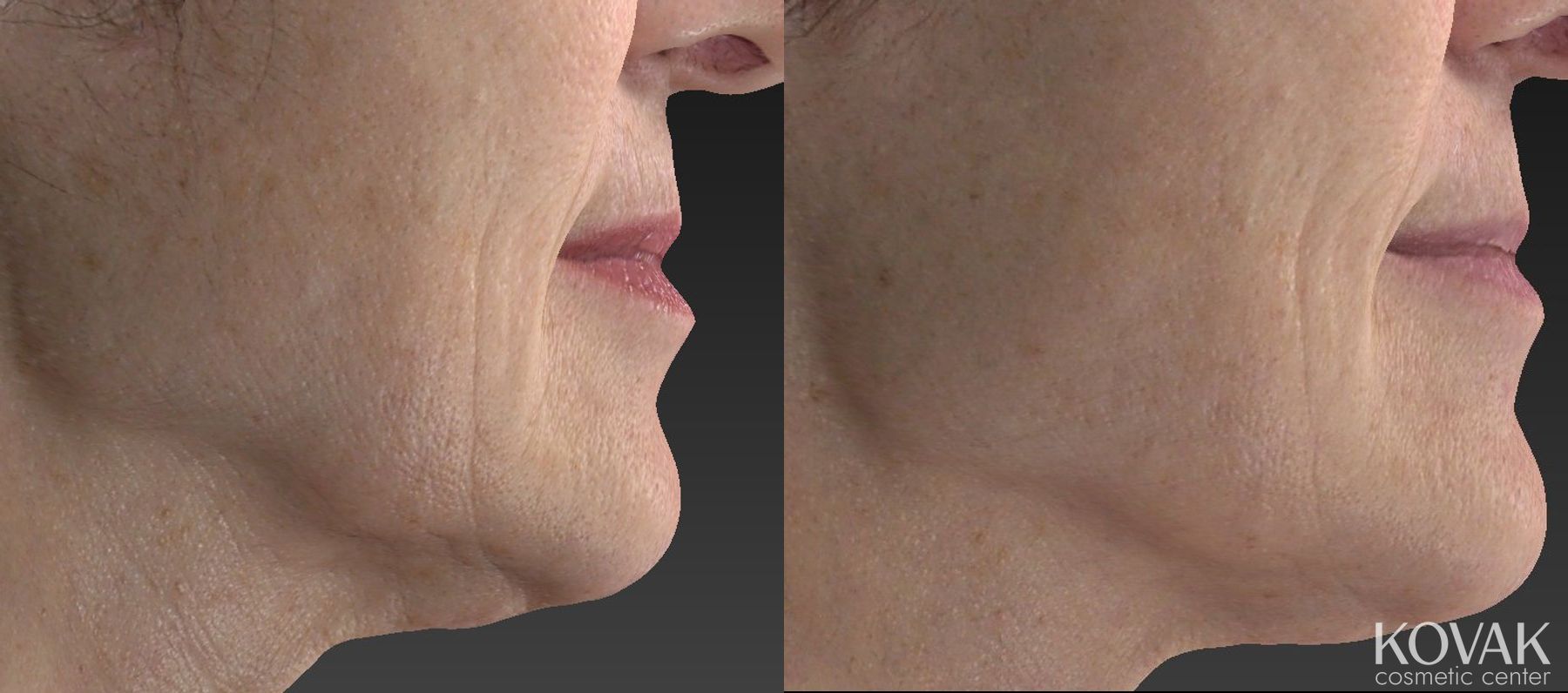 Before and after Restylane® Silk case 36462 - Angle 2
