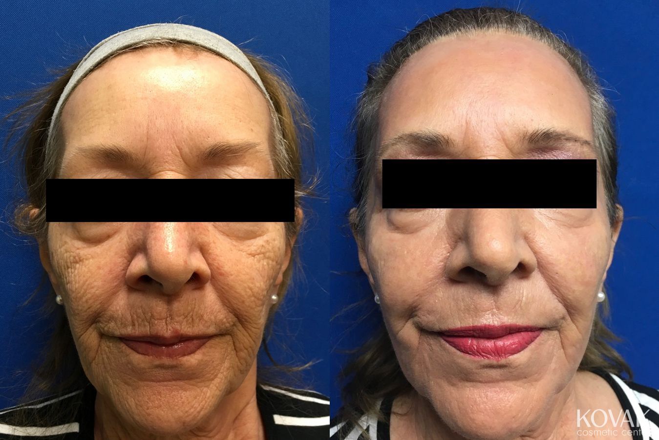 Before and after Laser Skin Resurfacing - Face case 36624