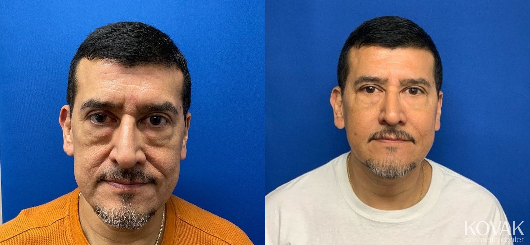 Before and after Sculptra® case 36768