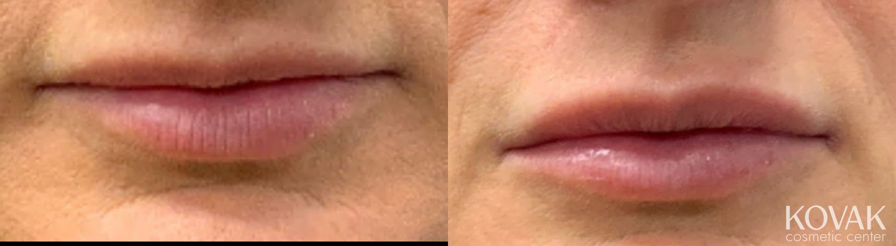 Before and after Lip Filler case 36734 - Angle 2