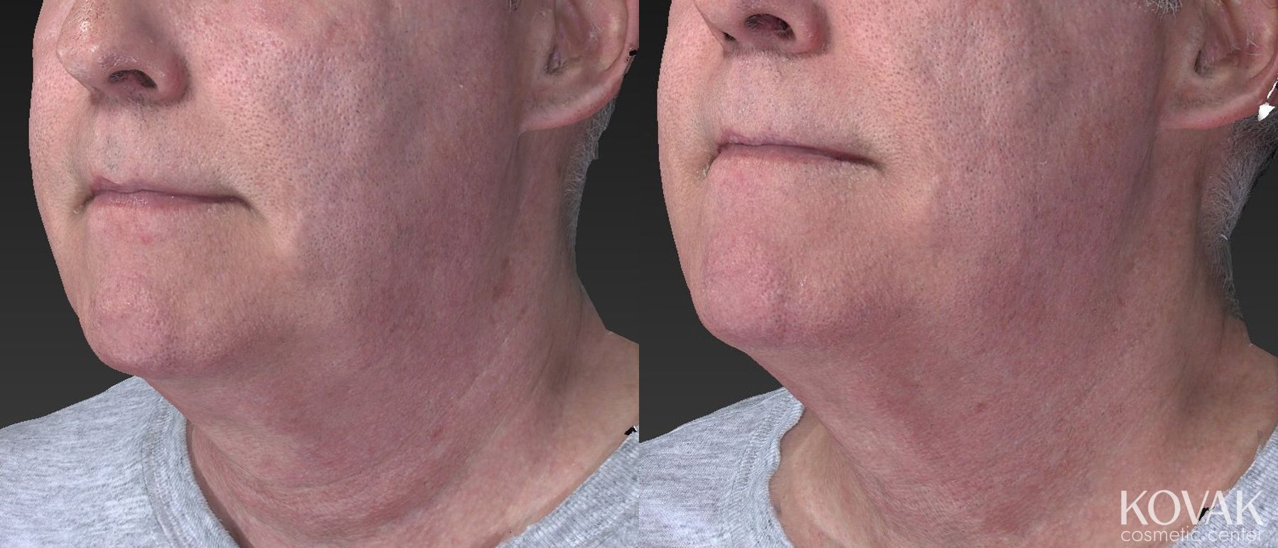 Before and after Injectables case 36638 - Angle 3