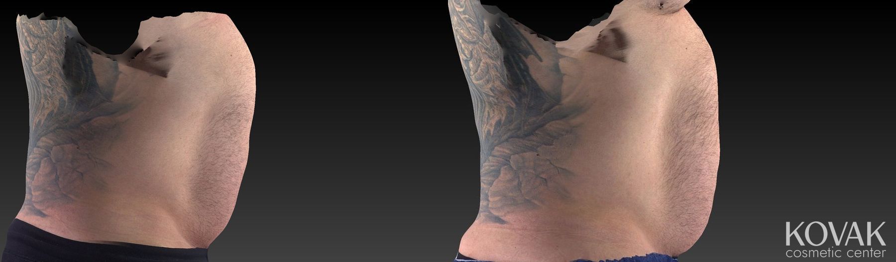 Before and after CoolSculpting® case 36562