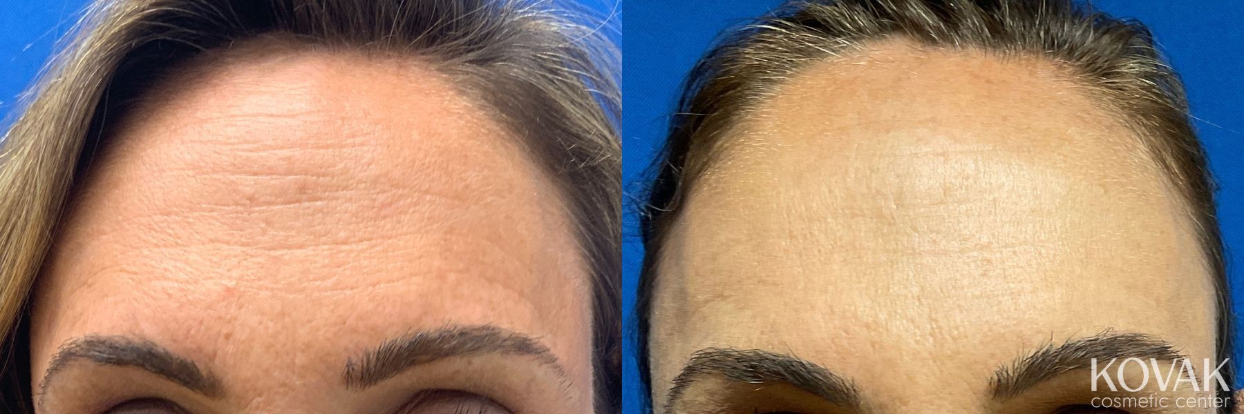 Before and after Thread lift case 36717