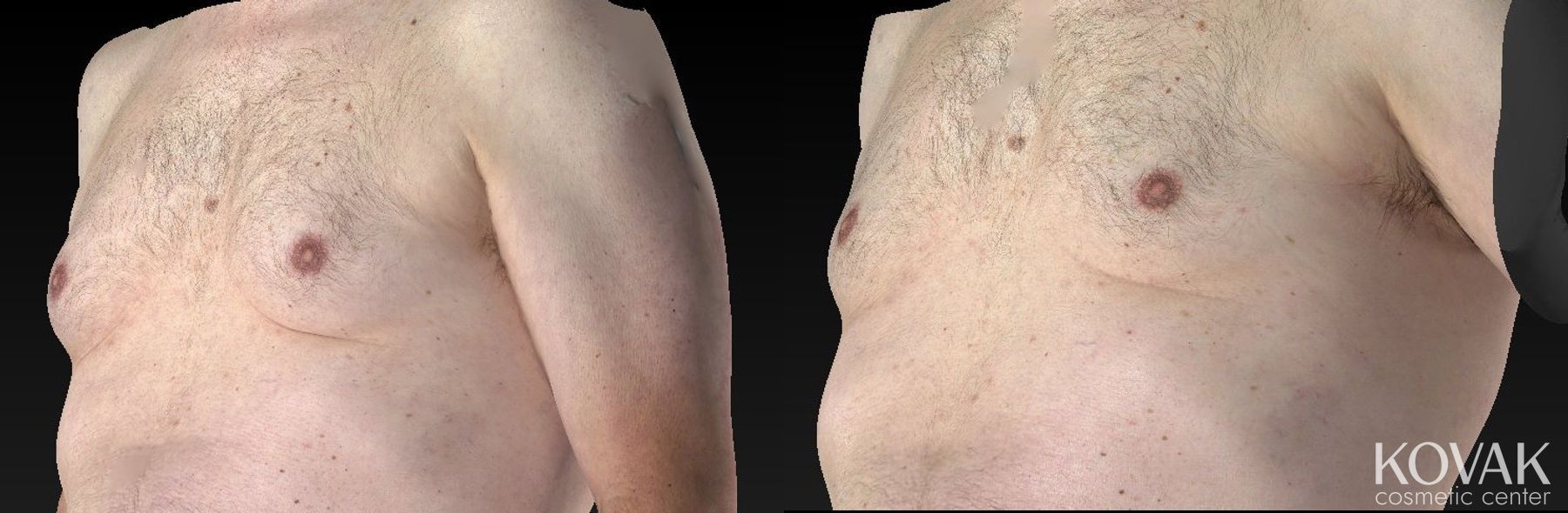 Before and after CoolSculpting® case 36475 - Angle 2