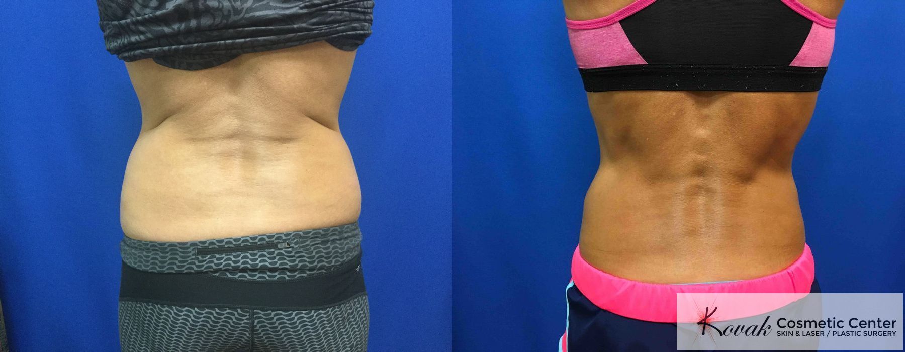 CoolSculpting® - Thumbnail 2