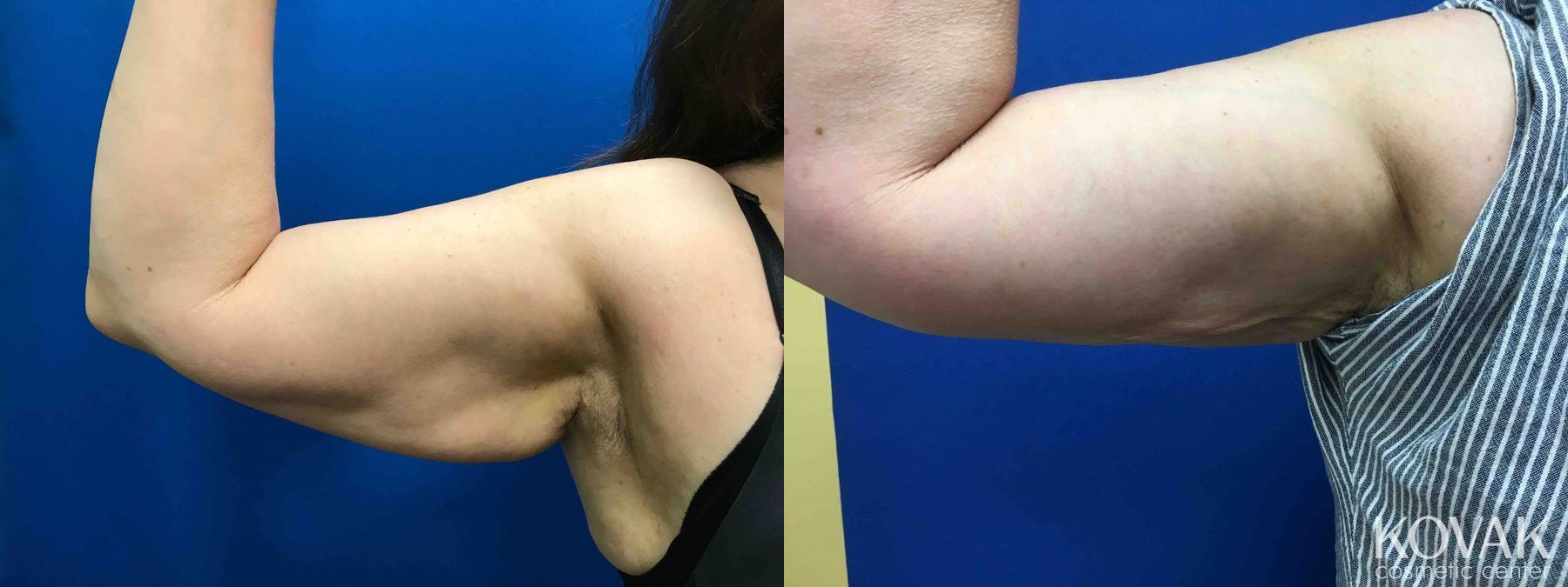 Before and after Laser Liposuction case 36662