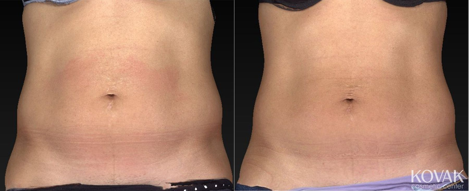 Before and after CoolSculpting® case 36479