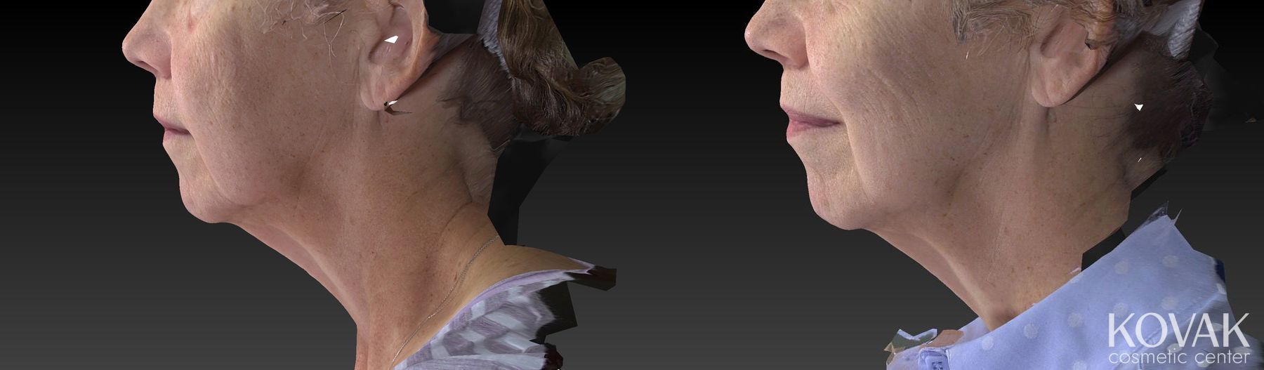 Before and after CoolSculpting® case 36456 - Angle 2