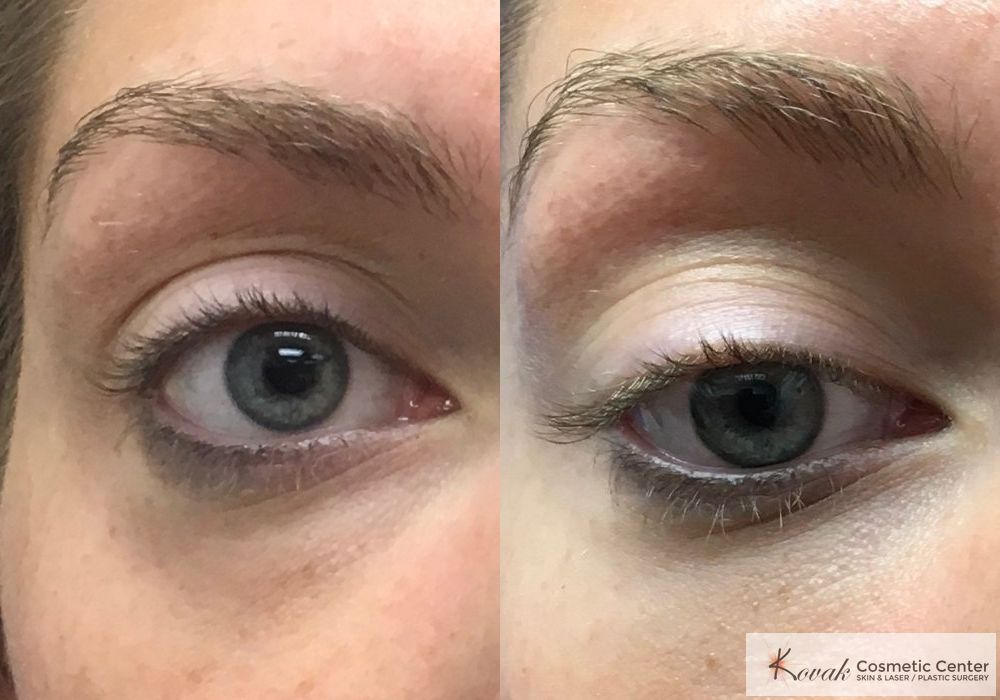 Eye Treatments - Case 1487