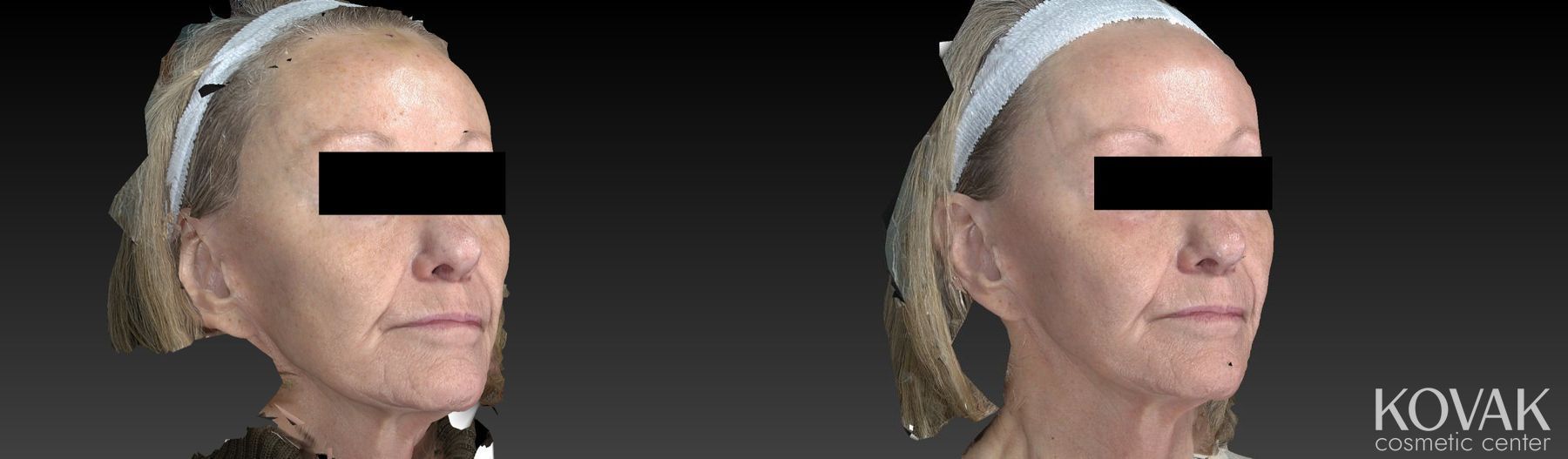 Before and after Halo™ case 36482 - Angle 4