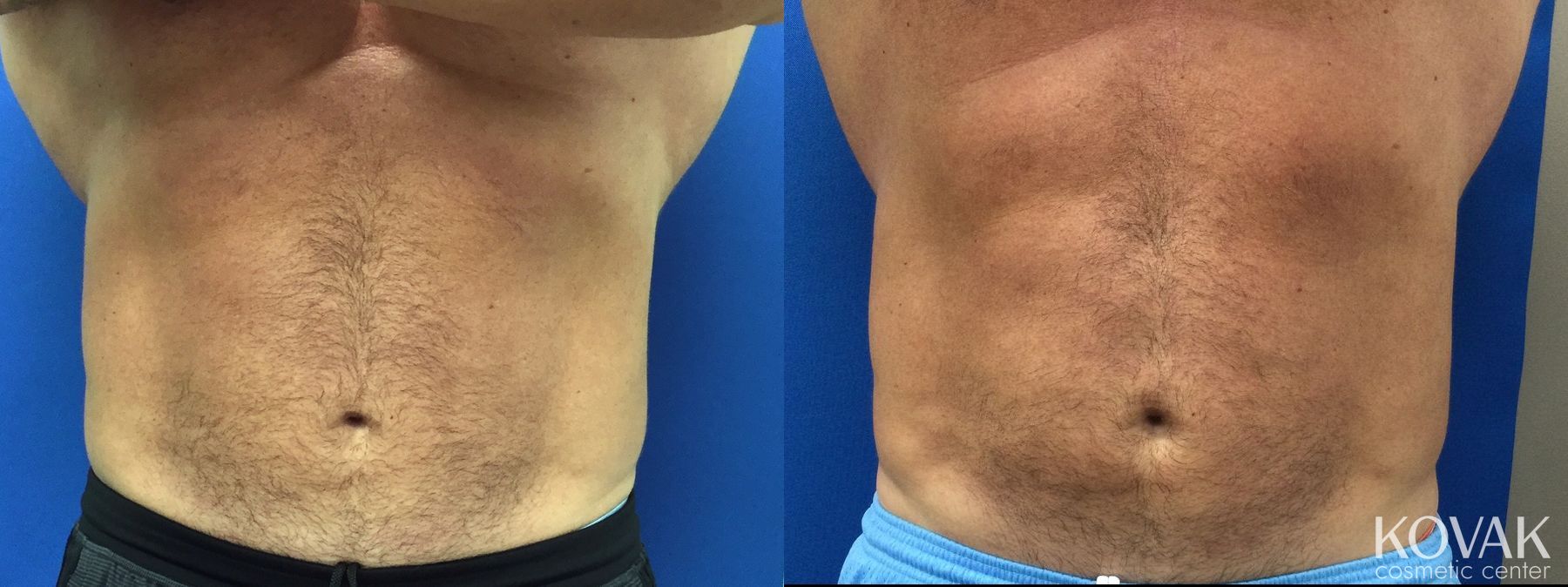 Before and after Emsculpt Neo case 36724