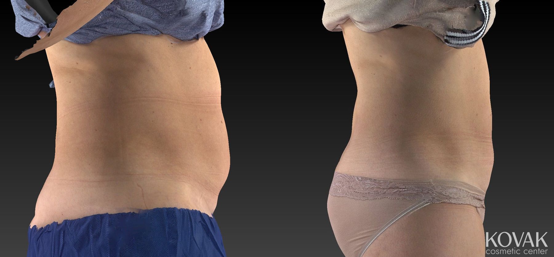Before and after CoolSculpting® case 36486 - Angle 5