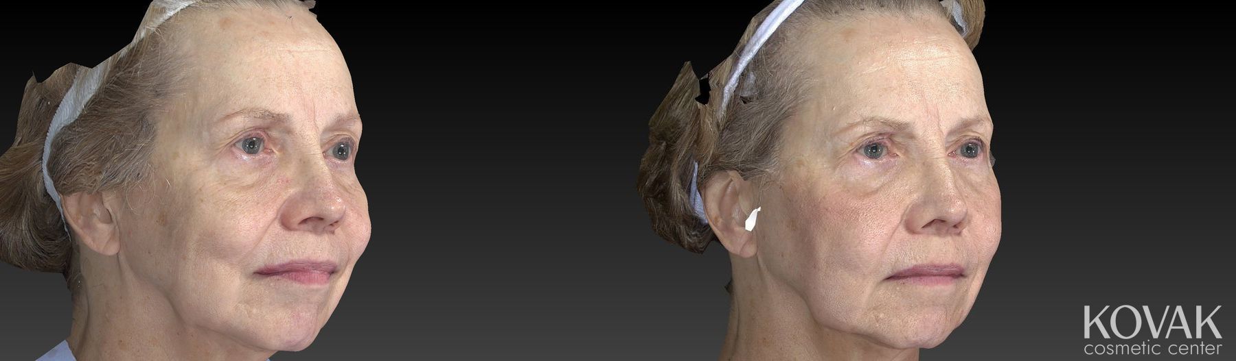 Before and after Sculptra® case 36561 - Angle 5