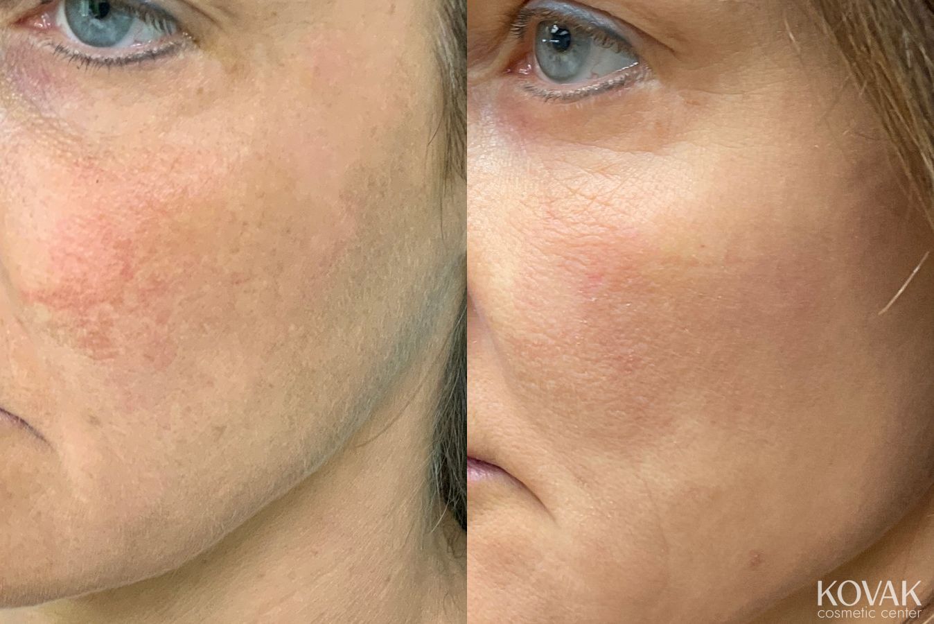 Before and after Rosacea case 36740