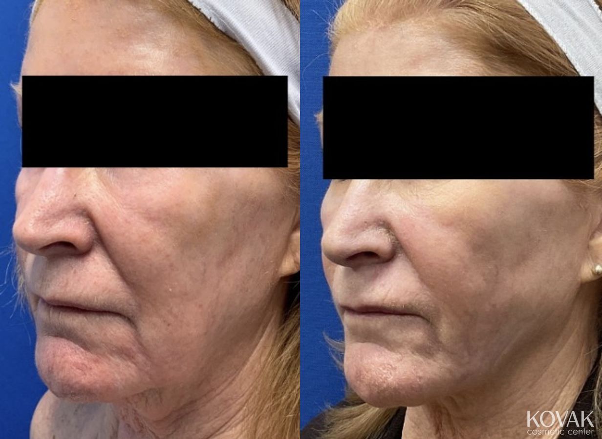 Before and after VLR - Vaser Laser - Jawline Sculpting case 36750