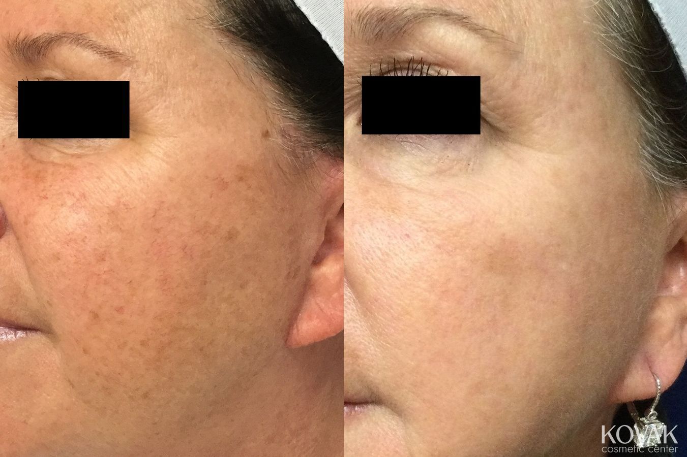 Before and after Tyte and Bryte Photorejuvenation case 36745 - Angle 2