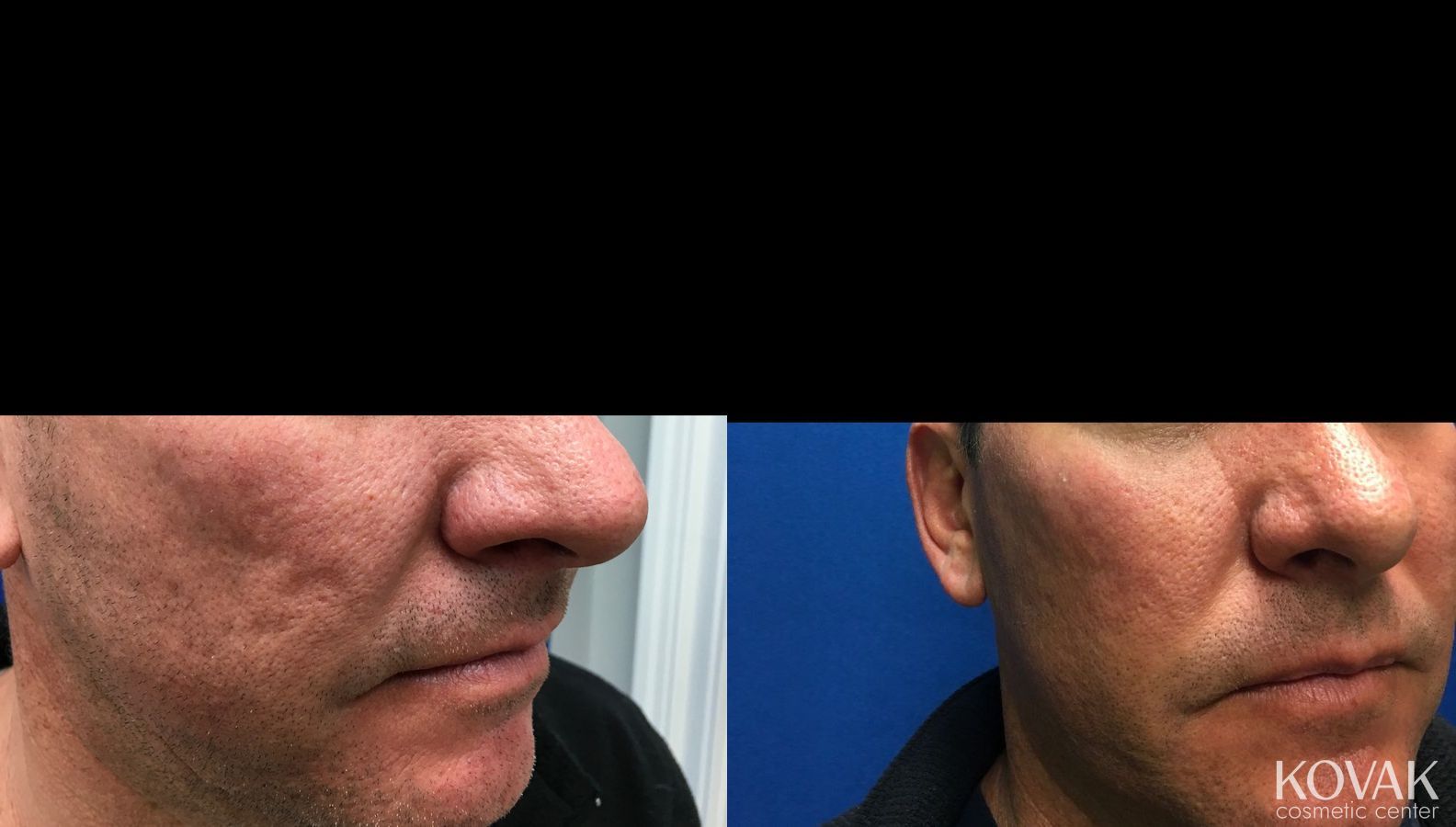 Before and after Juvéderm® XC case 36463
