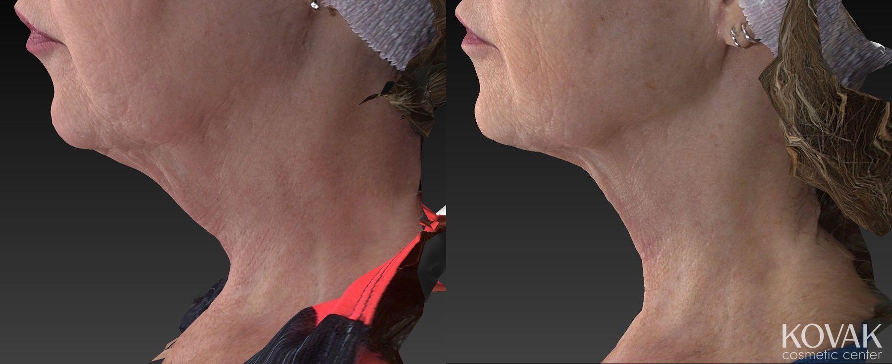 Before and after Kybella case 36483 - Angle 4