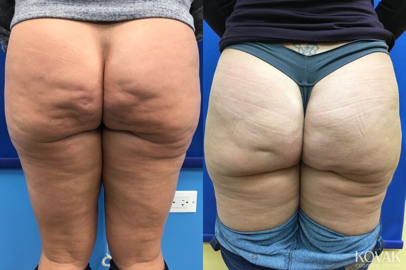 Before and after Cellulite Reduction case 36664