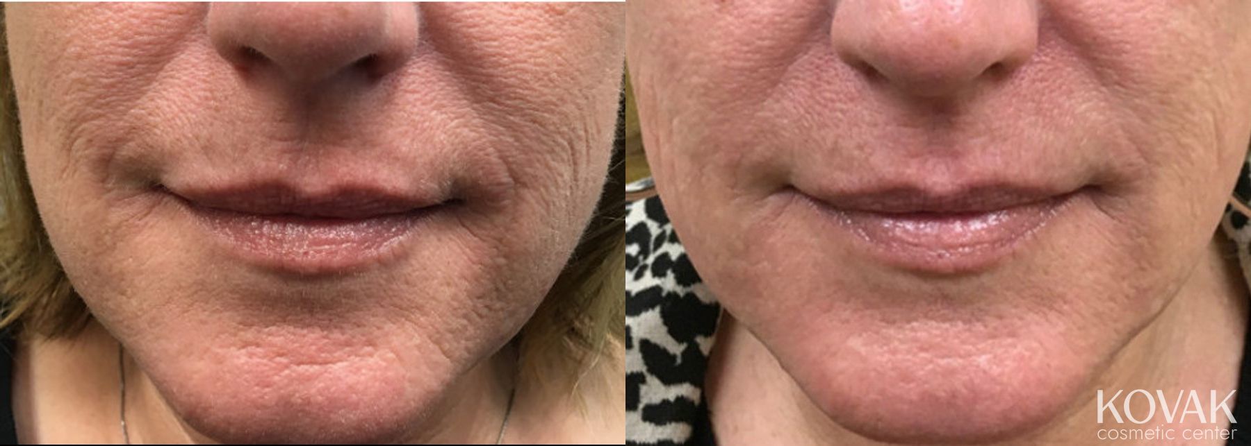Before and after Restylane® Silk case 36490