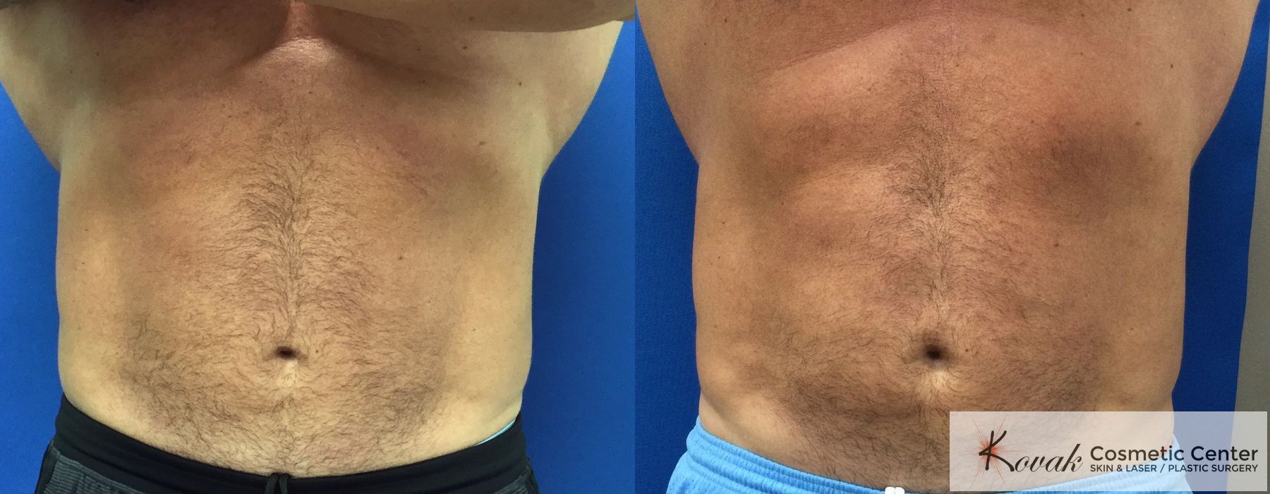 Emsculpt Neo - Case 1459