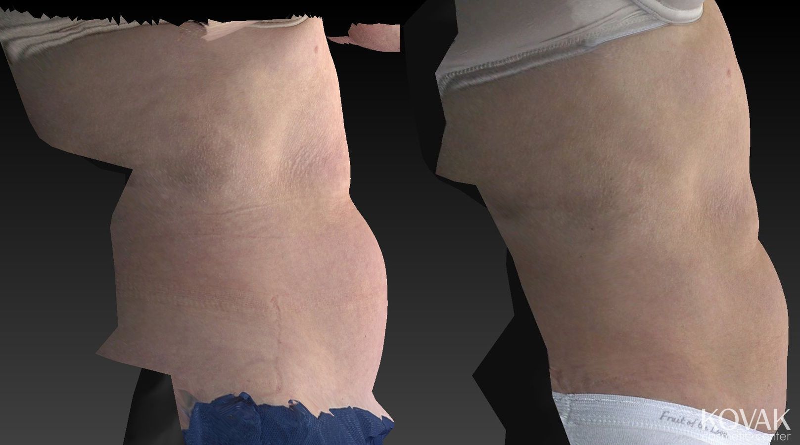 Before and after CoolSculpting® case 36484 - Angle 4