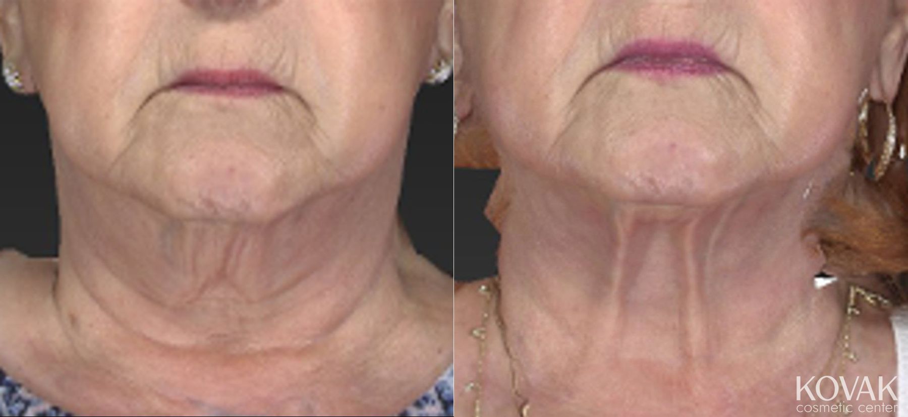 Before and after CoolSculpting® case 36455