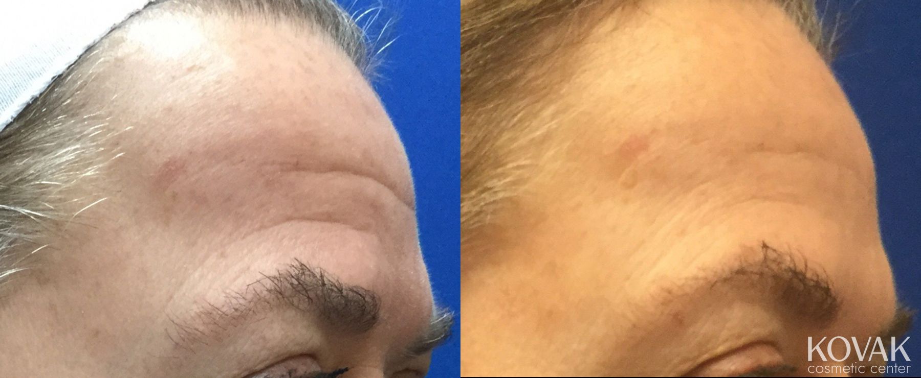 Before and after BOTOX® Cosmetic case 36643 - Angle 3