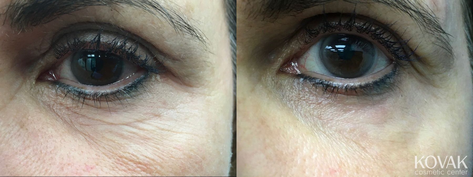 Before and after Eye Treatments case 36595 - Angle 2