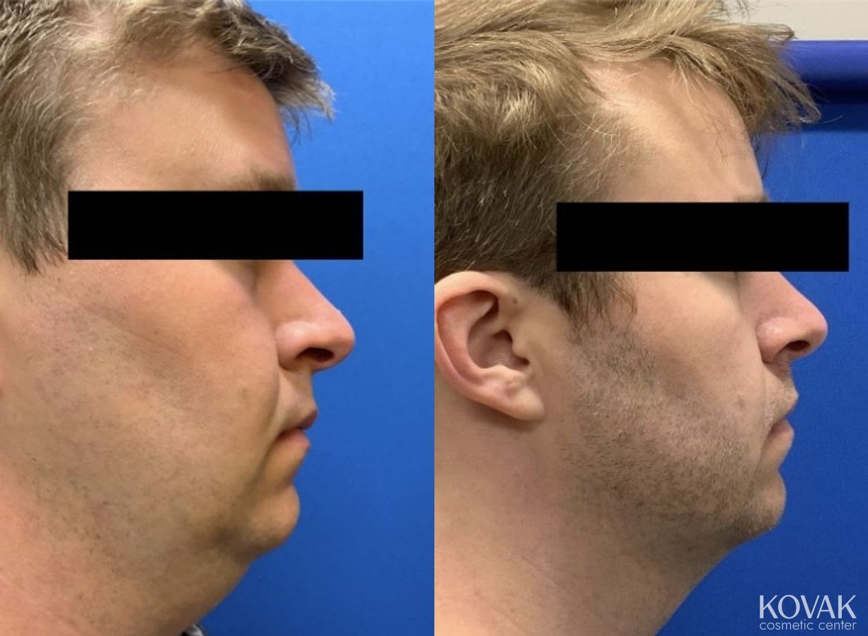 Before and after VLR - Vaser Laser - Jawline Sculpting case 36766 - Angle 2