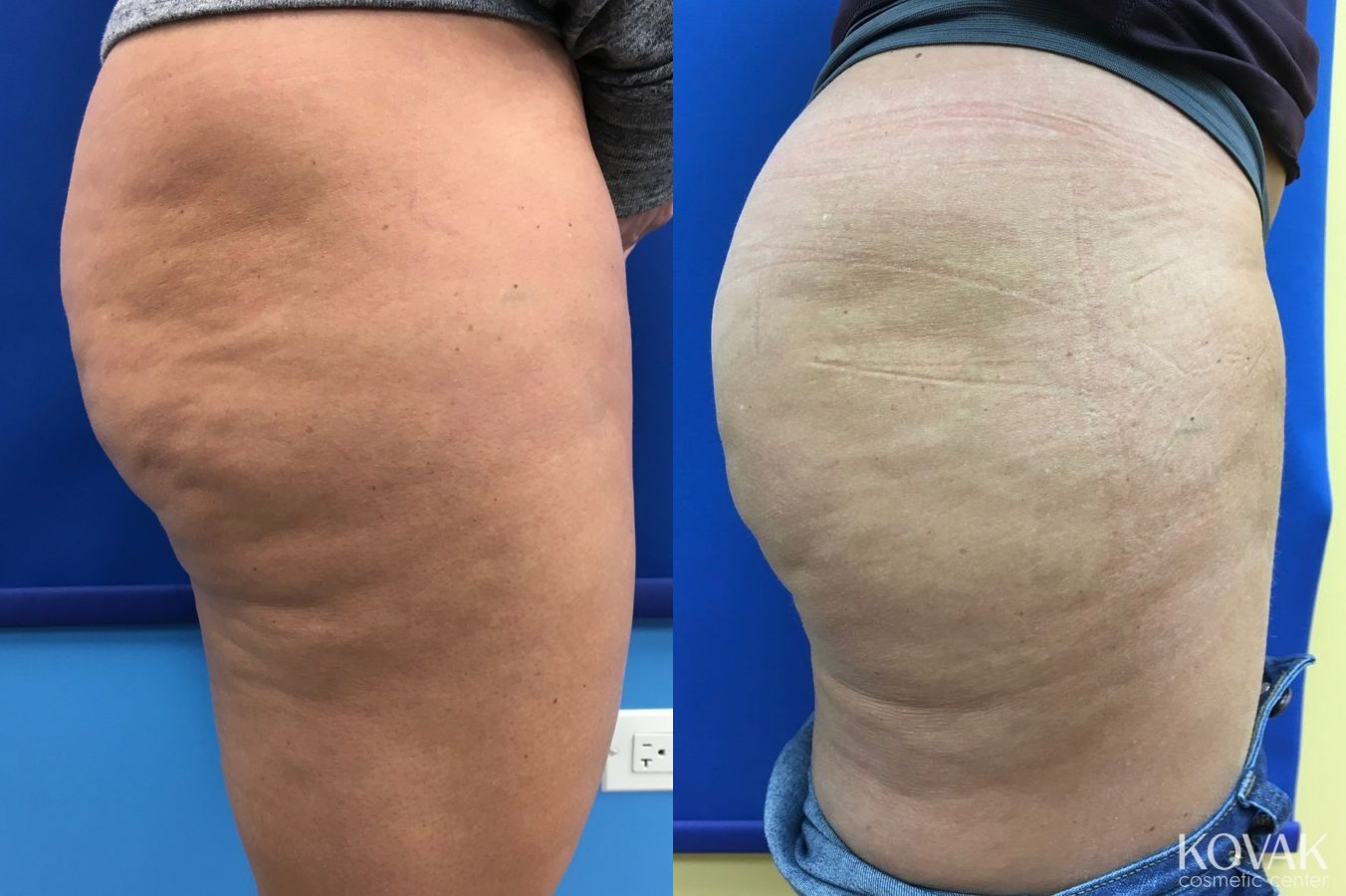 Before and after Cellulite Reduction case 36664 - Angle 2