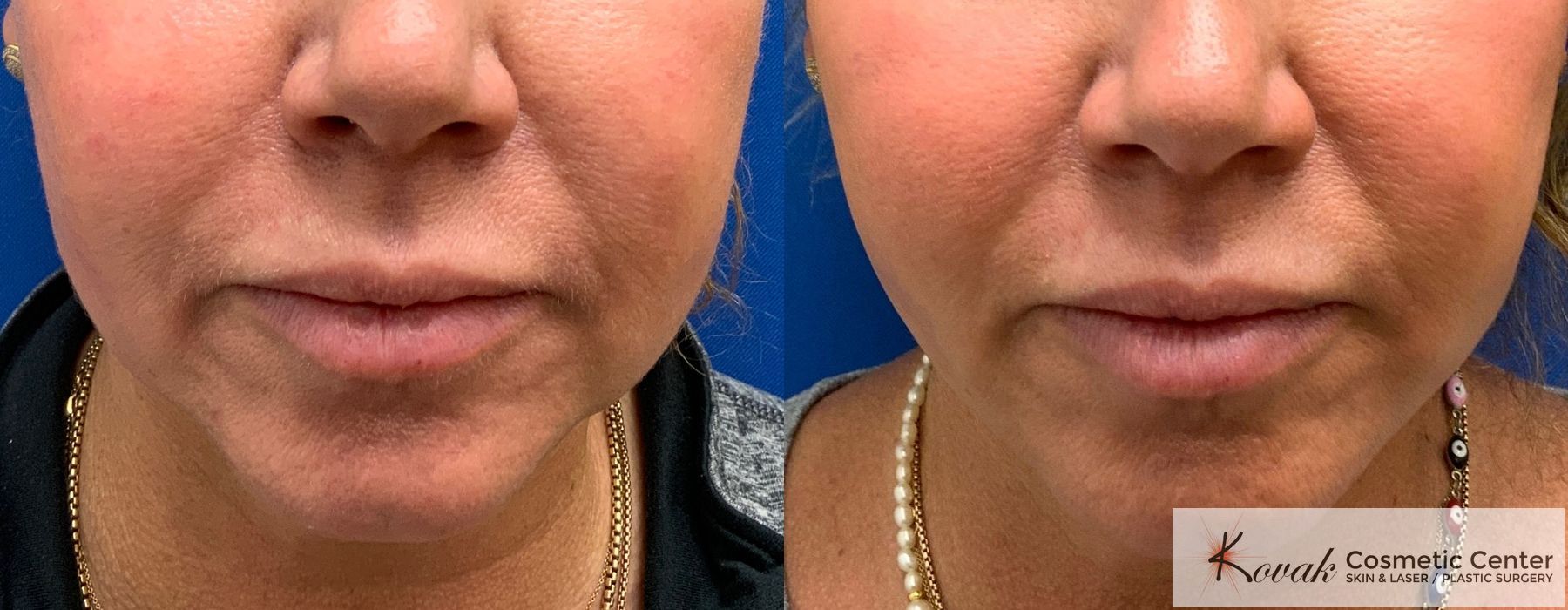 Laser Liposuction - Case 1462