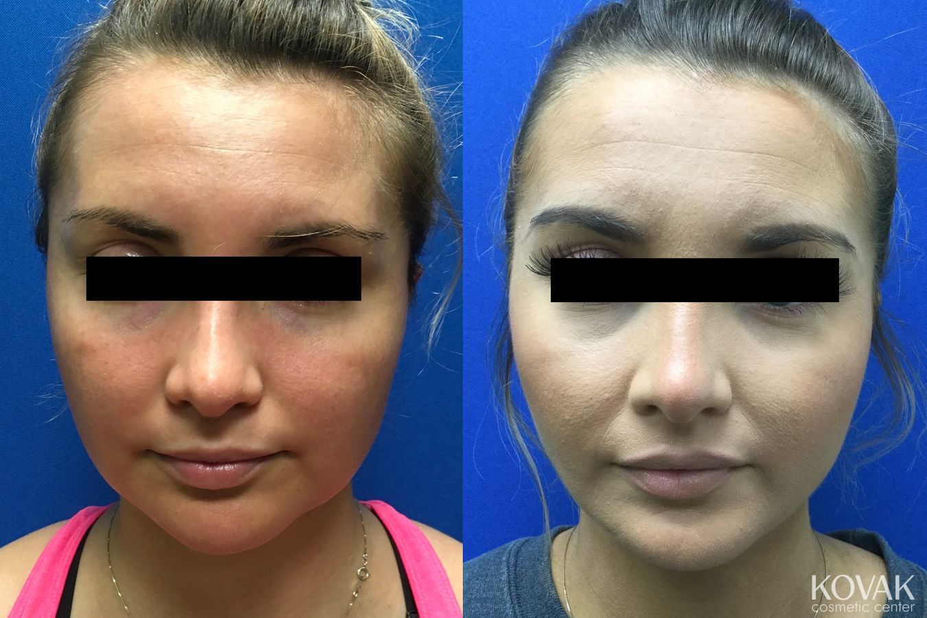 Before and after Laser Liposuction case 36705