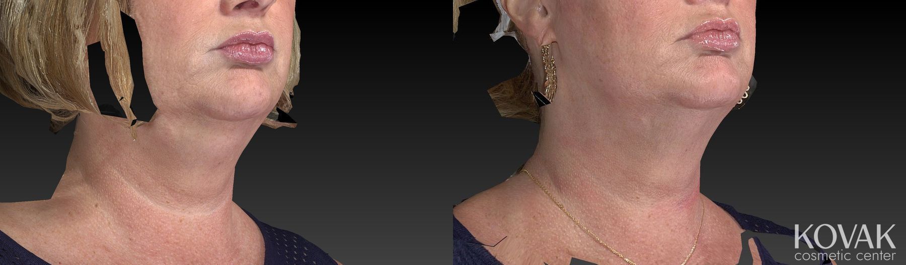 Before and after Kybella case 36478 - Angle 2