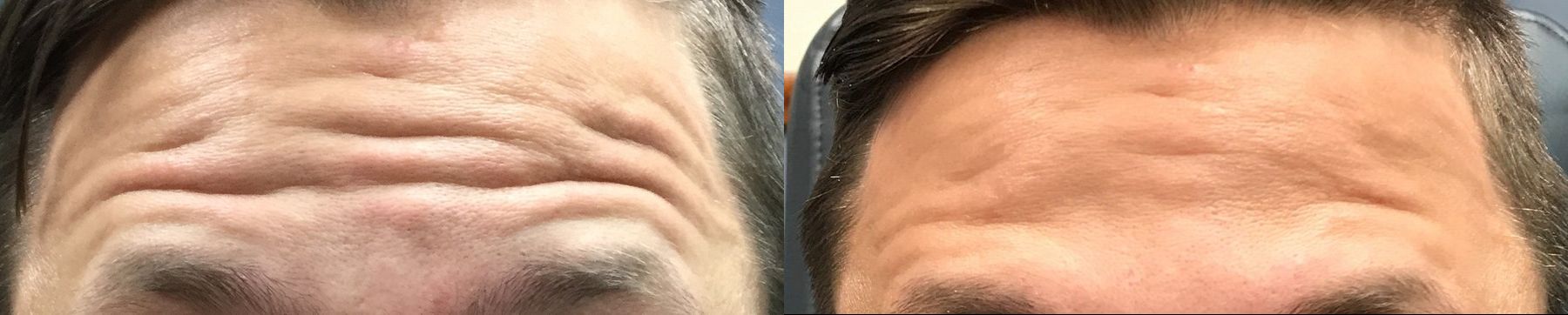 Before and after BOTOX® Cosmetic case 36503