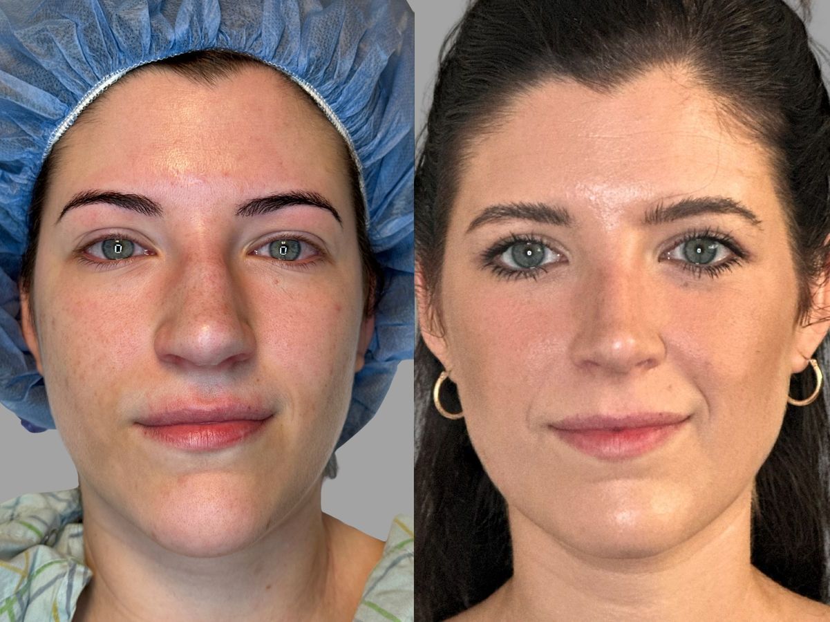 Before and after Primary Rhinoplasty case 31683