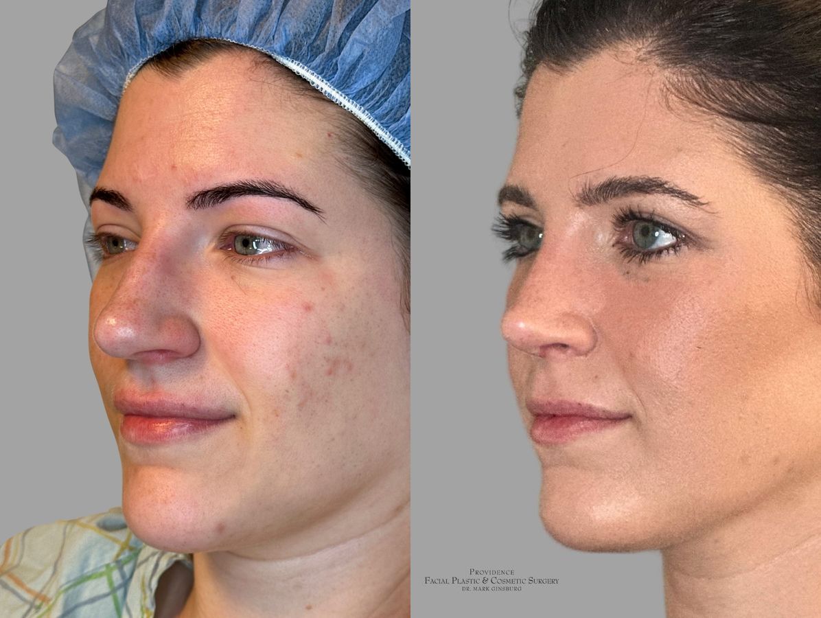 Before and after Primary Rhinoplasty case 31683 - Angle 4