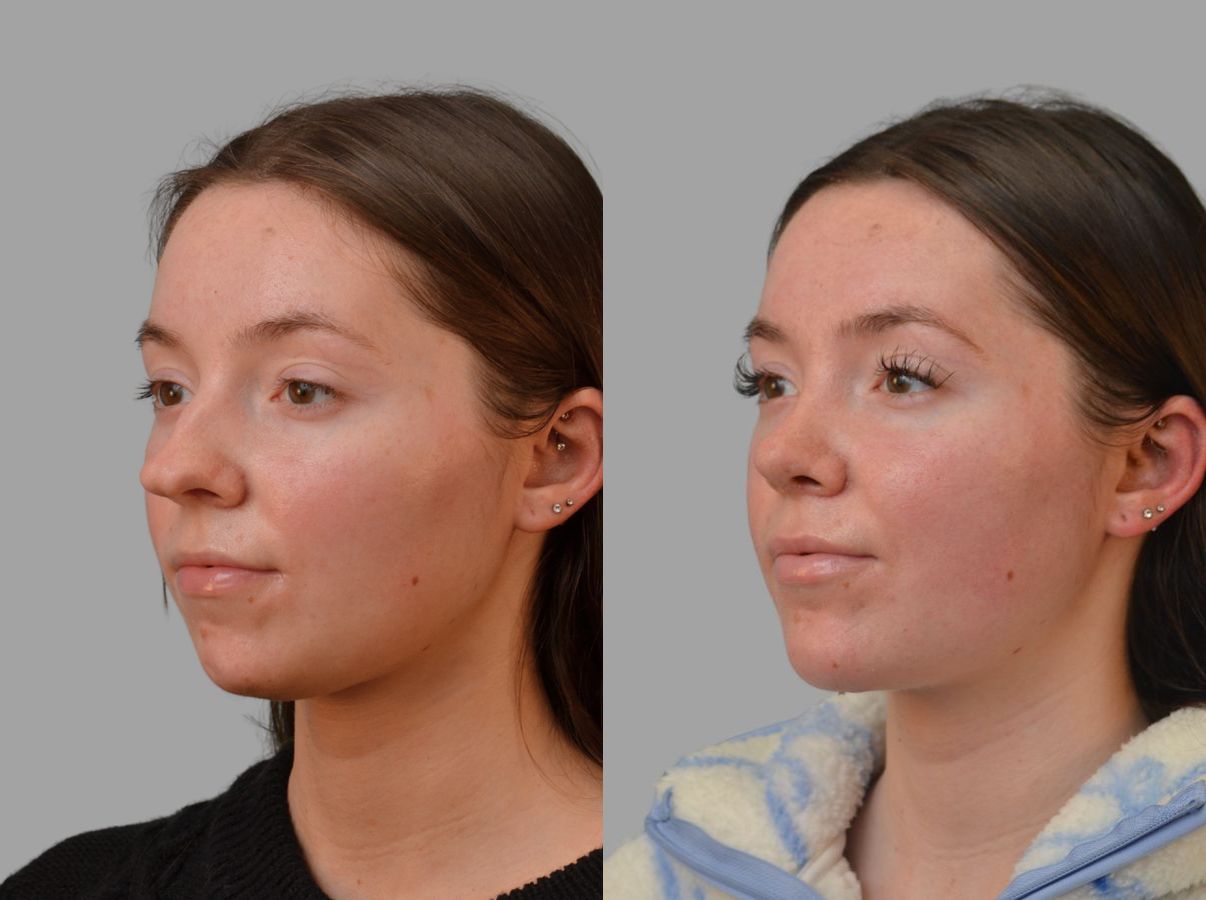 Before and after Primary Rhinoplasty case 43674 - Angle 2