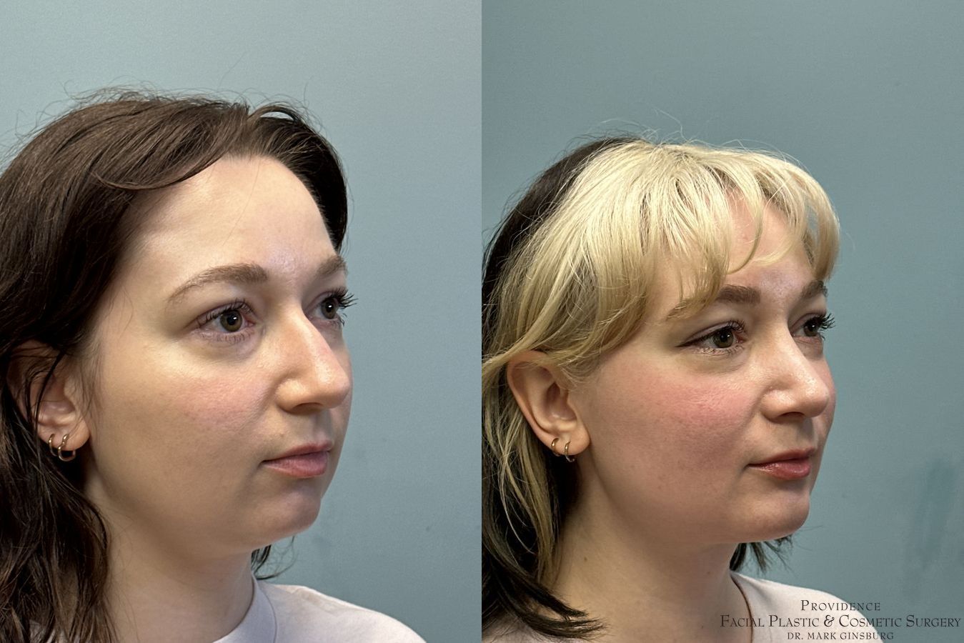 Before and after Chin Augmentation case 31644