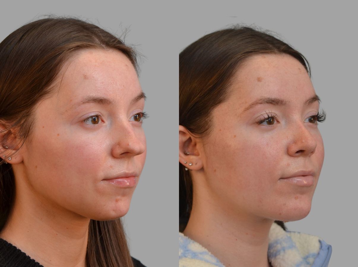 Before and after Primary Rhinoplasty case 43674 - Angle 6