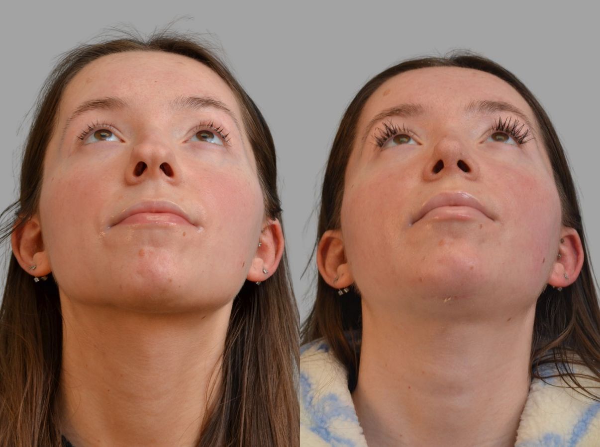 Before and after Primary Rhinoplasty case 43674 - Angle 5