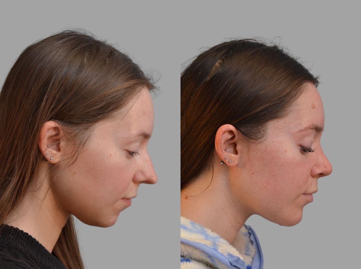 Before and after Primary Rhinoplasty case 43674 - Angle 8
