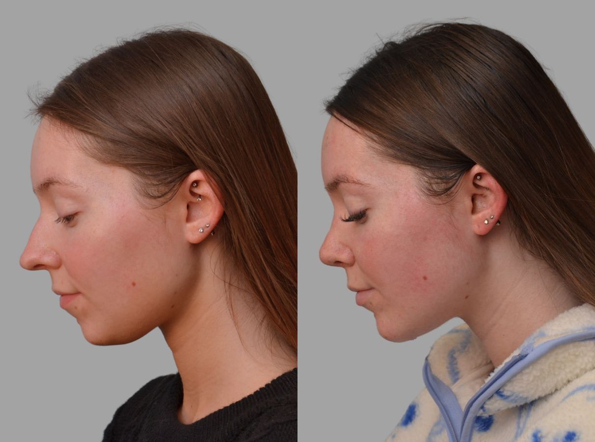 Before and after Primary Rhinoplasty case 43674 - Angle 9