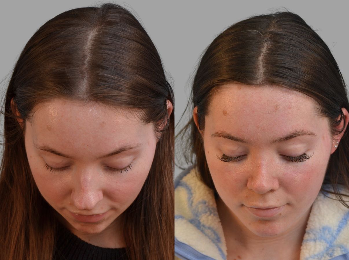 Before and after Primary Rhinoplasty case 43674 - Angle 4